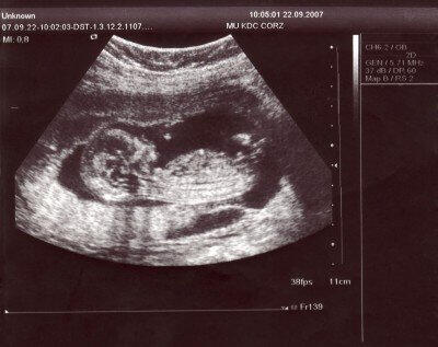 Těhotenský ultrazvuk Těhotenský ultrazvuk